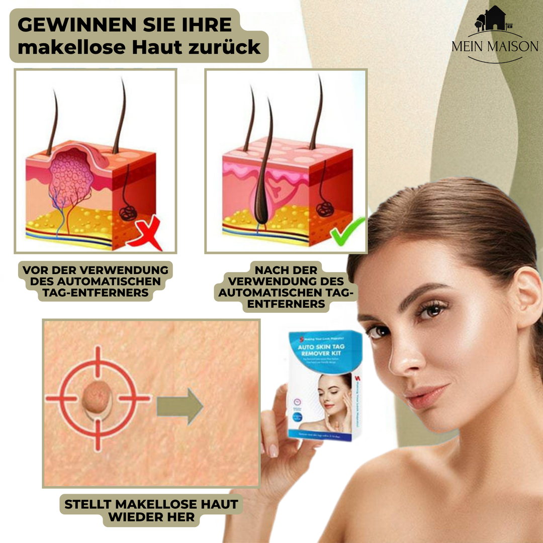 DermaLinx Wart Remover | Painless Removal of Warts and Moles | For Home Use | No Surgery