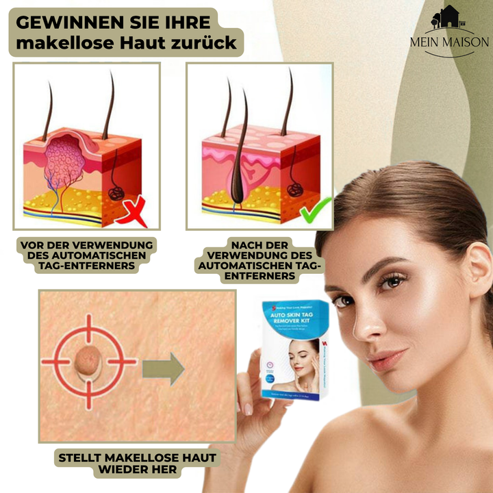 DermaLinx Wart Remover | Painless Removal of Warts and Moles | For Home Use | No Surgery