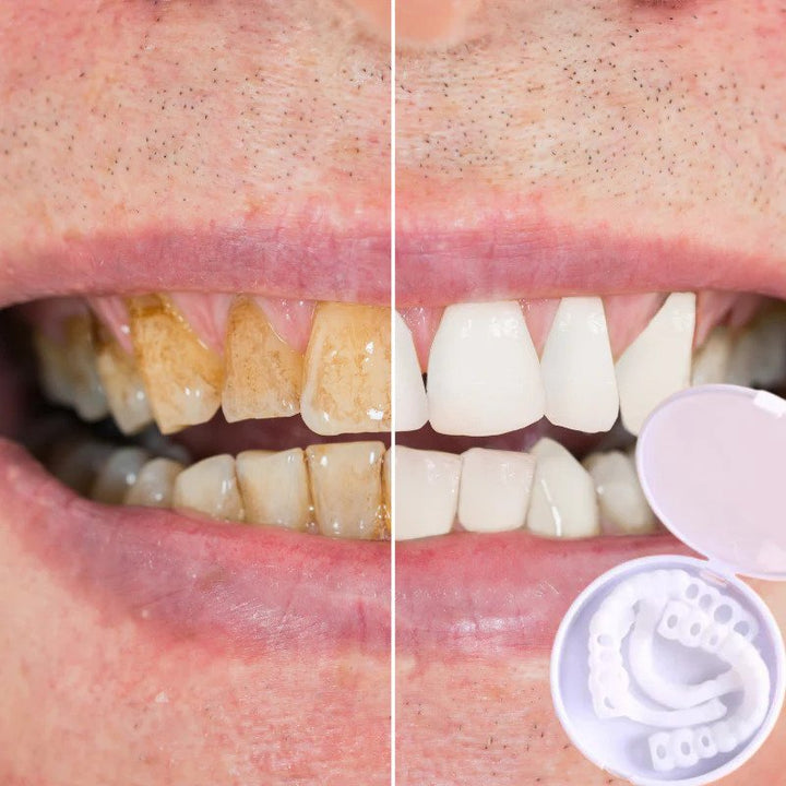 Snap-On Veneers | Flexible, Glue-Free Fit for Meals and Everyday Wear