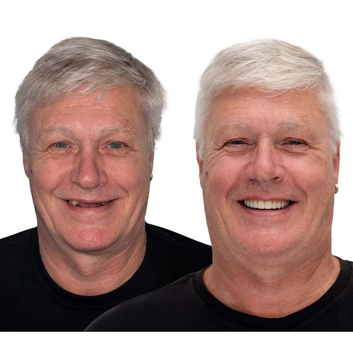 Affordable Removable Dentures with Flexible Cushion Grip Full Arch Set Cleaning